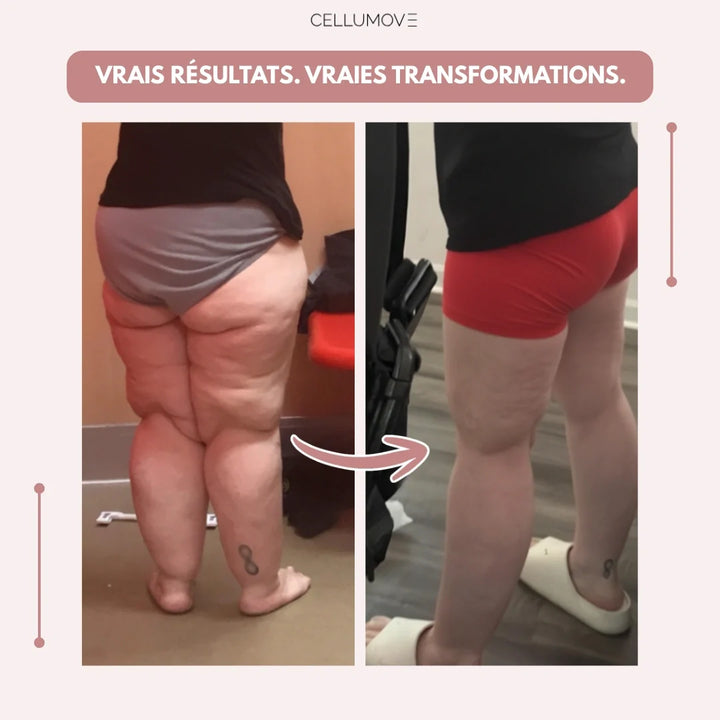 Legging 3D Cellumove – Dites adieu naturellement aux douleurs et gonflements du lipœdème